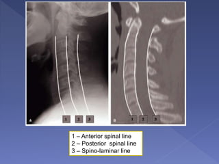 1 – Anterior spinal line
2 – Posterior spinal line
3 – Spino-laminar line
 