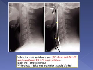 Yellow line – pre-vertebral space (C2 <6 mm and C6 <20
mm in adults and C6 < 14 mm in children)
Black line – smooth contour
White arrow – Bulge due to anterior tubercle of atlas
 