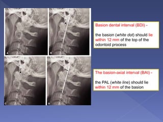 Basion dental interval (BDI) -
the basion (white dot) should lie
within 12 mm of the top of the
odontoid process
The basion-axial interval (BAI) -
the PAL (white line) should lie
within 12 mm of the basion
 