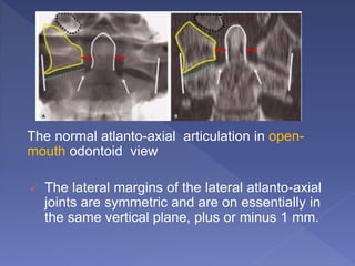 The normal atlanto-axial articulation in open-
mouth odontoid view
 The lateral margins of the lateral atlanto-axial
joints are symmetric and are on essentially in
the same vertical plane, plus or minus 1 mm.
 