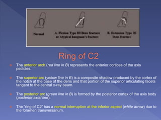  The anterior arch (red line in B) represents the anterior cortices of the axis
pedicles.
 The superior arc (yellow line in B) is a composite shadow produced by the cortex of
the notch at the base of the dens and that portion of the superior articulating facets
tangent to the central x-ray beam.
 The posterior arc (green line in B) is formed by the posterior cortex of the axis body
(posterior axial line).
 The “ring of C2” has a normal interruption at the inferior aspect (white arrow) due to
the foramen transversarium.
 