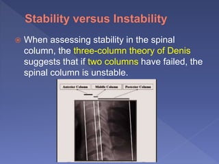  When assessing stability in the spinal
column, the three-column theory of Denis
suggests that if two columns have failed, the
spinal column is unstable.
 