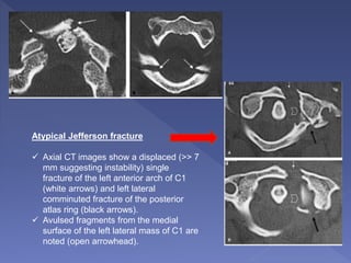 Atypical Jefferson fracture
 Axial CT images show a displaced (>> 7
mm suggesting instability) single
fracture of the left anterior arch of C1
(white arrows) and left lateral
comminuted fracture of the posterior
atlas ring (black arrows).
 Avulsed fragments from the medial
surface of the left lateral mass of C1 are
noted (open arrowhead).
 
