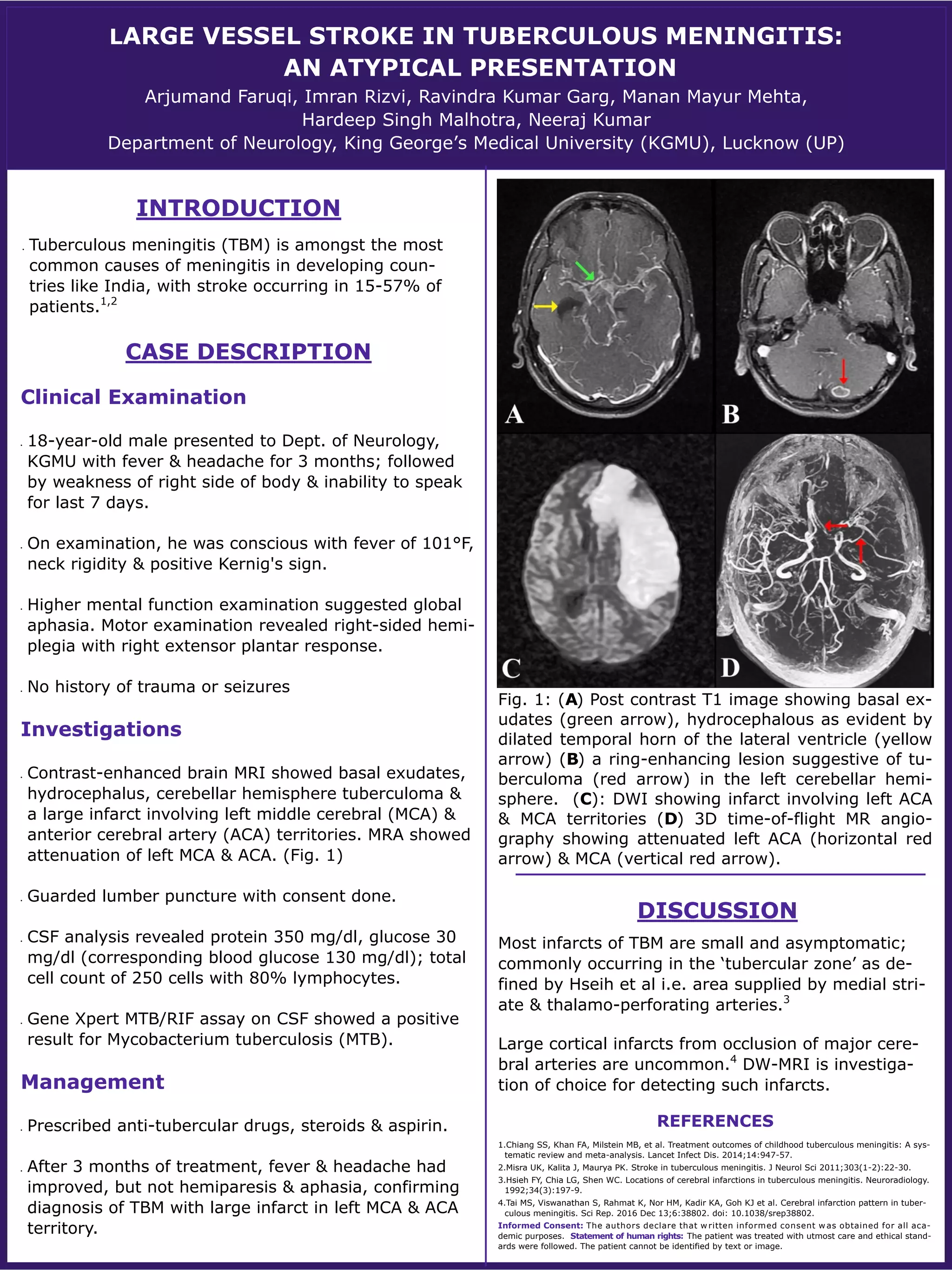 Large Vessel Stroke in Tuberculous Meningitis PDF
