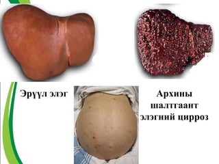 Эрүүл элэг Архины
шалтгаант
элэгний цирроз
 