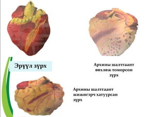 Эрүүл зүрх Архины шалтгаант
өөхлөж томорсон
зүрх
Архины шалтгаант
жижигэрч хатуурсан
зүрх
 