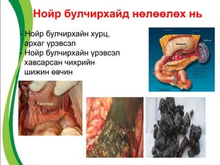 Нойр булчирхайд нөлөөлөх нь
- Нойр булчирхайн хурц,
архаг үрэвсэл
- Нойр булчирхайн үрэвсэл
хавсарсан чихрийн
шижин өвчин
 