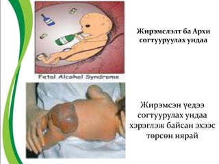 Жирэмслэлт ба Архи
согтууруулах ундаа
Жирэмсэн үедээ
согтуурулах ундаа
хэрэглэж байсан эхээс
төрсөн нярай
 