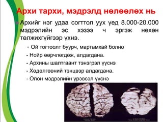  Архийг нэг удаа согттол уух үед 8.000-20.000
мэдрэлийн эс хэзээ ч эргэж нөхөн
төлжихгүйгээр үхнэ.
- Ой тогтоолт буурч, мартамхай болно
- Нойр өөрчлөгдөж, алдагдана.
- Архины шалтгаант тэнэгрэл үүснэ
- Хөдөлгөөний тэнцвэр алдагдана.
- Олон мэдрэлийн үрэвсэл үүснэ
Архи тархи, мэдрэлд нөлөөлөх нь
 