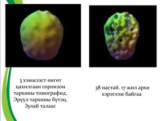 3 хэмжээст өнгөт
цахилгаан соронзон
тархины томографид.
Эрүүл тархины бүтэц.
Зулай талаас
38 настай. 17 жил архи
хэрэглэж байгаа
 