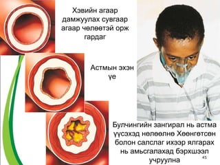45
Хэвийн агаар
дамжуулах сувгаар
агаар чөлөөтэй орж
гардаг
Астмын эхэн
үе
Булчингийн зангирал нь астма
үүсэхэд нөлөөлнө Хөөнгөтсөн
болон салслаг ихээр ялгарах
нь амьсгалахад бэрхшээл
учруулна
 