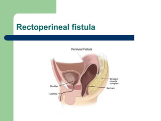 Rectoperineal fistula
 