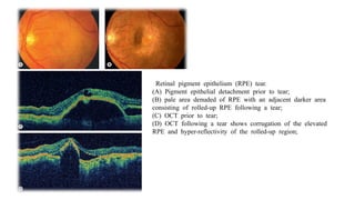 ARMD(age related macular degeneration).pptx