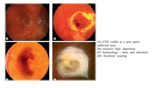 Disciform Macula ARMD(age related macular degeneration).pptx