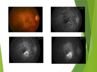 ARMD.pptx age related macular degeneration | PPTX