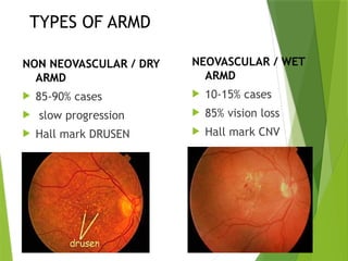ARMD.pptx age related macular degeneration | PPTX