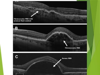 ARMD.pptx age related macular degeneration | PPTX
