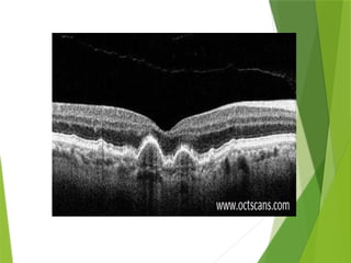 ARMD.pptx age related macular degeneration | PPTX