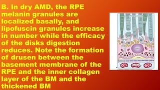 B. In dry AMD, the RPE
melanin granules are
localized basally, and
lipofuscin granules increase
in number while the efficacy
of the disks digestion
reduces. Note the formation
of drusen between the
basement membrane of the
RPE and the inner collagen
layer of the BM and the
thickened BM
 