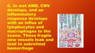 C. In wet AMD, CNV
develops, and an
inflammatory
response develops
with an influx of
lymphocytes and
macrophages to the
scene. These fragile
new vessels leak and
lead to subretinal
hemorrhage
 