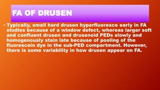 FA OF DRUSEN
• Typically, small hard drusen hyperfluoresce early in FA
studies because of a window defect, whereas larger soft
and confluent drusen and drusenoid PEDs slowly and
homogenously stain late because of pooling of the
fluorescein dye in the sub-PED compartment. However,
there is some variability in how drusen appear on FA.
 