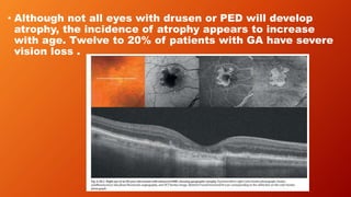 • Although not all eyes with drusen or PED will develop
atrophy, the incidence of atrophy appears to increase
with age. Twelve to 20% of patients with GA have severe
vision loss .
 