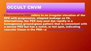 OCCULT CNVM
• Fibrovascular PED refers to an irregular elevation of the
RPE with progressive, stippled leakage on FA.
Alternatively, the PED may pool dye rapidly in a
homogenous ground-glass pattern that is consistent with
a serous PED but has a notch, or hot spot, indicating
vascular tissue in the PED—a vascularized serous PED
 