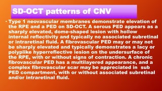SD-OCT patterns of CNV
• Type 1 neovascular membranes demonstrate elevation of
the RPE and a PED on SD-OCT. A serous PED appears as a
sharply elevated, dome-shaped lesion with hollow
internal reflectivity and typically no associated subretinal
or intraretinal fluid. A fibrovascular PED may or may not
be sharply elevated and typically demonstrates a lacy or
polyplike hyperreflective lesion on the undersurface of
the RPE, with or without signs of contraction. A chronic
fibrovascular PED has a multilayered appearance, and a
complex fibrovascular scar may be appreciated in sub
PED compartment, with or without associated subretinal
and/or intraretinal fluid.
 