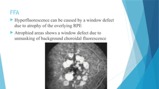 Age Related Macular Degeneration - ARMD | PPTX
