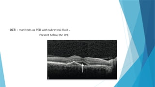 Fluid Below Rpe Age Related Macular Degeneration - ARMD | PPTX