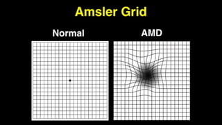 ARMD age related macular degeneration slides | PPTX
