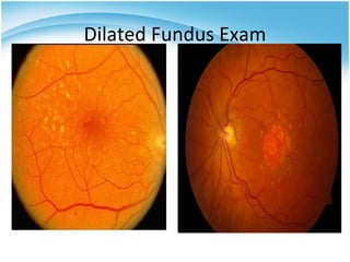 Dilated Fundus Exam
 