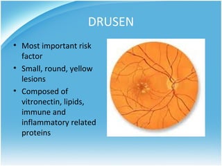 DRUSEN
• Most important risk
  factor
• Small, round, yellow
  lesions
• Composed of
  vitronectin, lipids,
  immune and
  inflammatory related
  proteins
 