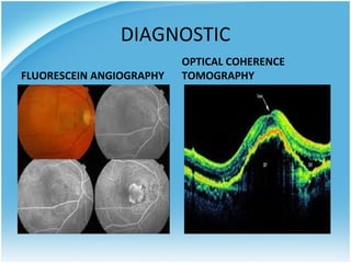 DIAGNOSTIC
                          OPTICAL COHERENCE
FLUORESCEIN ANGIOGRAPHY   TOMOGRAPHY
 