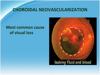 CHOROIDAL NEOVASCULARIZATION


Most common cause
 of visual loss
 