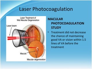 Laser Photocoagulation
           MACULAR
            PHOTOCOAGULATION
            STUDY
           • Treatment did not decrease
             the chance of maintaining
             good VA or vision within 1.5
             lines of VA before the
             treatment
 