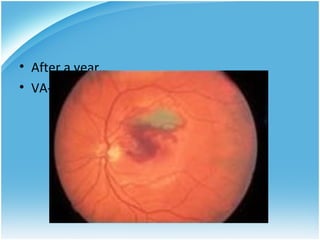 • After a year…
• VA- 20/100, OD   HM, OS
 