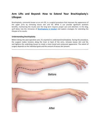 Arm Lifts and Beyond: How to Extend Your Brachioplasty's
Lifespan
Brachioplasty, commonly known as an arm lift, is a surgical procedure that improves the appearance of
the upper arms by removing excess skin and fat. While it can provide significant aesthetic
benefits, maintaining the results over the long term requires proper care and attention. In this blog,
we'll delve into the intricacies of Brachioplasty in Istanbul and explore strategies for extending the
lifespan of its results.
Understanding Brachioplasty
Before diving into post-operative care, it's essential to understand brachioplasty. During the procedure,
the surgeon makes incisions along the inner or back of the arms, removes excess skin and fat,
and tightens the underlying tissues to create a more toned and contoured appearance. The extent of
surgery depends on the individual goals and the amount of excess skin present.
 