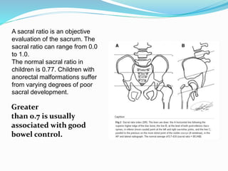 A sacral ratio is an objective
evaluation of the sacrum. The
sacral ratio can range from 0.0
to 1.0.
The normal sacral ratio in
children is 0.77. Children with
anorectal malformations suffer
from varying degrees of poor
sacral development.
Greater
than 0.7 is usually
associated with good
bowel control.
 