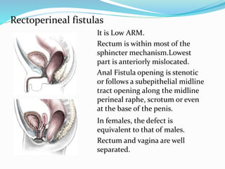Rectoperineal fistulas
It is Low ARM.
Rectum is within most of the
sphincter mechanism.Lowest
part is anteriorly mislocated.
Anal Fistula opening is stenotic
or follows a subepithelial midline
tract opening along the midline
perineal raphe, scrotum or even
at the base of the penis.
In females, the defect is
equivalent to that of males.
Rectum and vagina are well
separated.
 