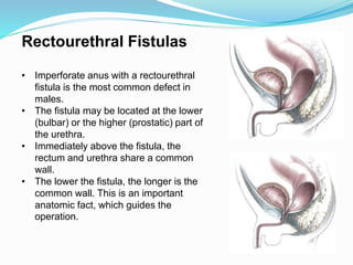 Rectourethral Fistulas
• Imperforate anus with a rectourethral
fistula is the most common defect in
males.
• The fistula may be located at the lower
(bulbar) or the higher (prostatic) part of
the urethra.
• Immediately above the fistula, the
rectum and urethra share a common
wall.
• The lower the fistula, the longer is the
common wall. This is an important
anatomic fact, which guides the
operation.
 