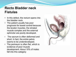 • The sacrum is often deformed and
short. In fact, the entire pelvis
seems to be underdeveloped.
• The perineum is often flat, which is
evidence of poor muscle
development. About 10% of males
fall into this category
Recto Bladder neck
Fistulas
• In this defect, the rectum opens into
the bladder neck.
• The patient usually has poor
prognosis for bowel control because
the levator muscles, the striated
muscle complex and the external
sphincter are poorly developed.
 