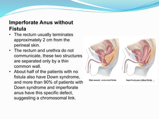 Imperforate Anus without
Fistula
• The rectum usually terminates
approximately 2 cm from the
perineal skin.
• The rectum and urethra do not
communicate, these two structures
are separated only by a thin
common wall.
• About half of the patients with no
fistula also have Down syndrome,
and more than 90% of patients with
Down syndrome and imperforate
anus have this specific defect,
suggesting a chromosomal link.
 