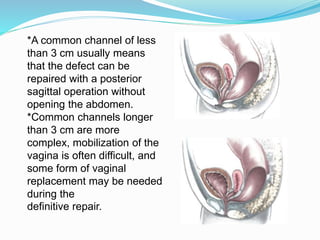 *A common channel of less
than 3 cm usually means
that the defect can be
repaired with a posterior
sagittal operation without
opening the abdomen.
*Common channels longer
than 3 cm are more
complex, mobilization of the
vagina is often difficult, and
some form of vaginal
replacement may be needed
during the
definitive repair.
 
