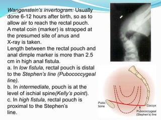 Wangenstein’s invertogram: Usually
done 6-12 hours after birth, so as to
allow air to reach the rectal pouch.
A metal coin (marker) is strapped at
the presumed site of anus and
X-ray is taken.
Length between the rectal pouch and
anal dimple marker is more than 2.5
cm in high anal fistula.
a. In low fistula, rectal pouch is distal
to the Stephen’s line (Pubococcygeal
line).
b. In intermediate, pouch is at the
level of ischial spine(Kelly’s point).
c. In high fistula, rectal pouch is
proximal to the Stephen’s
line.
 