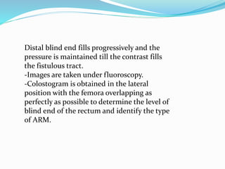 Distal blind end fills progressively and the
pressure is maintained till the contrast fills
the fistulous tract.
-Images are taken under fluoroscopy.
-Colostogram is obtained in the lateral
position with the femora overlapping as
perfectly as possible to determine the level of
blind end of the rectum and identify the type
of ARM.
 