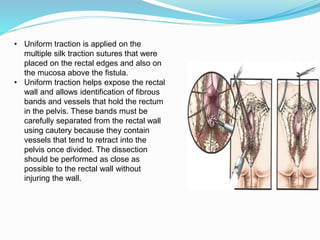 • Uniform traction is applied on the
multiple silk traction sutures that were
placed on the rectal edges and also on
the mucosa above the fistula.
• Uniform traction helps expose the rectal
wall and allows identification of fibrous
bands and vessels that hold the rectum
in the pelvis. These bands must be
carefully separated from the rectal wall
using cautery because they contain
vessels that tend to retract into the
pelvis once divided. The dissection
should be performed as close as
possible to the rectal wall without
injuring the wall.
 