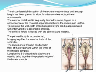 The circumferential dissection of the rectum must continue until enough
length has been gained to allow for a tension-free rectoperineal
anastomosis.
The anterior rectal wall is frequently thinned to some degree as a
consequence of the mucosal separation between the rectum and urethra.
To reinforce this wall, both smooth muscle layers can be approximated
with interrupted 5-0 absorbable stitches.
The urethral fistula is closed with the same suture material.
The perineal body is reconstructed,
bringing together the anterior limits of the
sphincter.
The rectum must then be positioned in
front of the levator and within the limits of
the muscle complex.
Long lasting 5-0 absorbable stitches are
used to bring together the posterior edge of
the levator muscle.
 