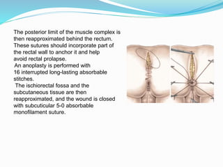 The posterior limit of the muscle complex is
then reapproximated behind the rectum.
These sutures should incorporate part of
the rectal wall to anchor it and help
avoid rectal prolapse.
An anoplasty is performed with
16 interrupted long-lasting absorbable
stitches.
The ischiorectal fossa and the
subcutaneous tissue are then
reapproximated, and the wound is closed
with subcuticular 5-0 absorbable
monofilament suture.
 