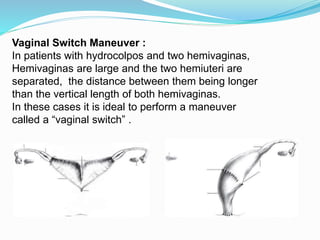 Vaginal Switch Maneuver :
In patients with hydrocolpos and two hemivaginas,
Hemivaginas are large and the two hemiuteri are
separated, the distance between them being longer
than the vertical length of both hemivaginas.
In these cases it is ideal to perform a maneuver
called a “vaginal switch” .
 